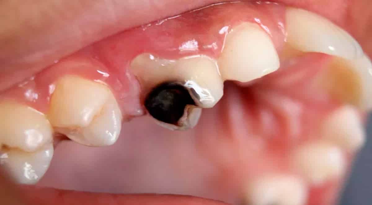 Passos simples para aliviar naturalmente e remineralizar os dentes cariados