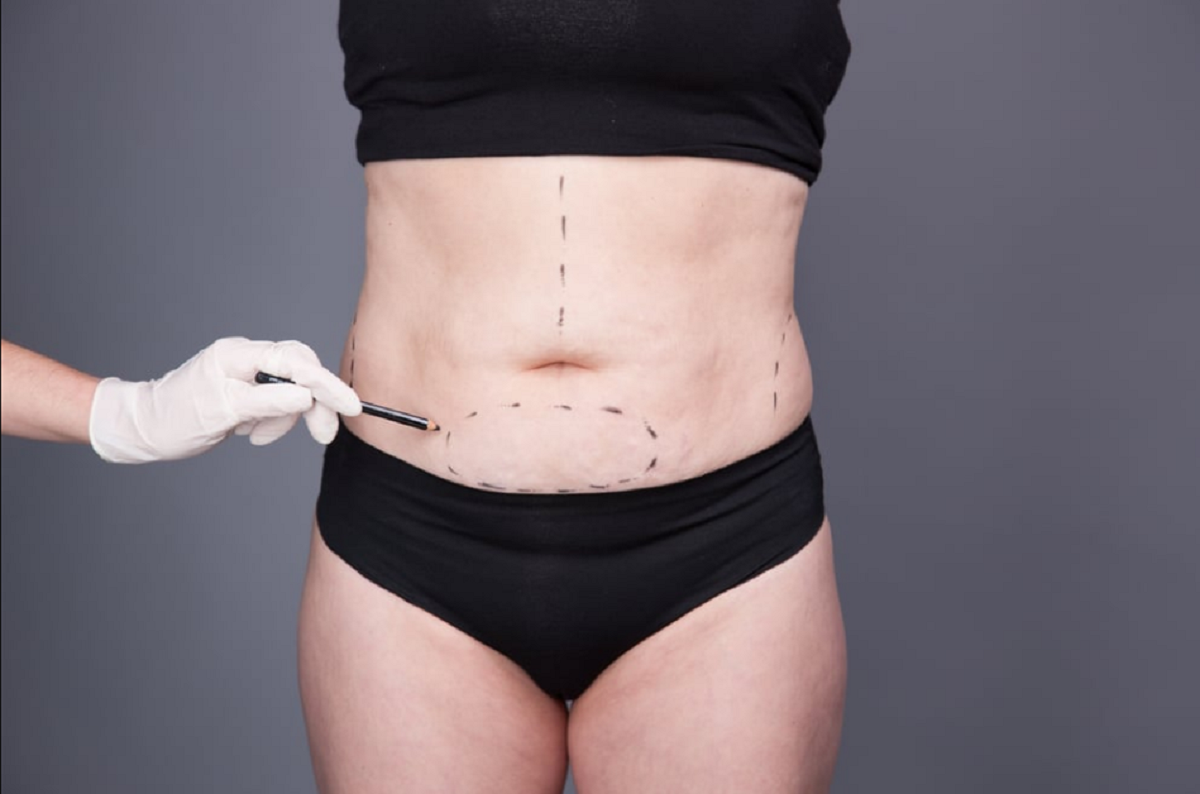 Que tipo de abdominoplastia é ideal para você?